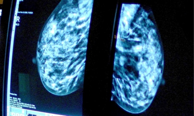 Mammogram-009