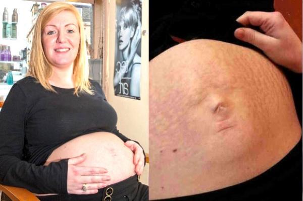 ¡Insólito! Está embarazada y el rostro del bebé se refleja en su abdomen