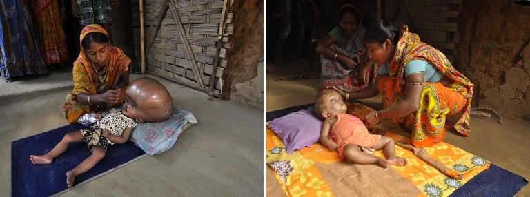 La niña india que padece hidrocefalia salió del hospital (Fotos)