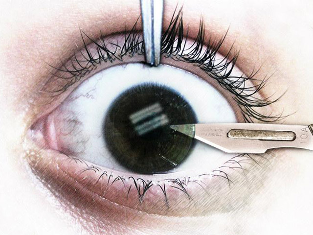 Le implantan un diente en un ojo y recupera la visión