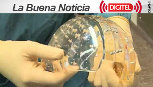 Implantan por primera vez un cráneo entero hecho con impresora 3D (Fotos)