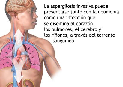 ¿Sabes que es la aspergilosis?