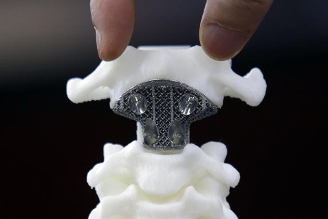 Médicos implantan con éxito un esternón fabricado con impresora 3D