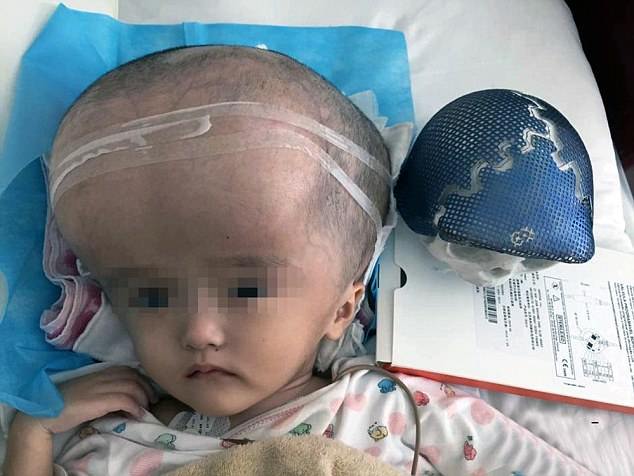 Bebe de tres años recibió trasplante de cráneo construido con impresora 3D