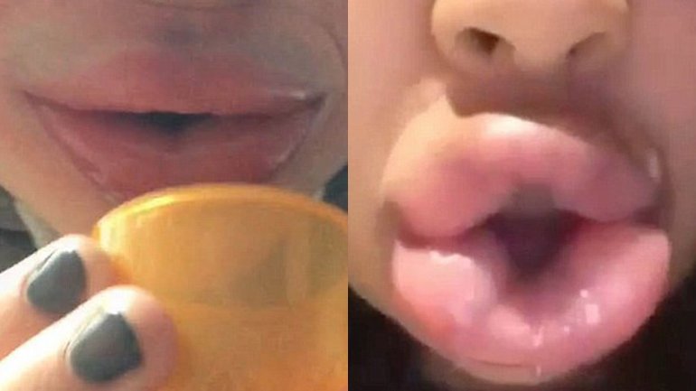 Los riesgos del dilatador de labios por succión, la última moda estética en internet