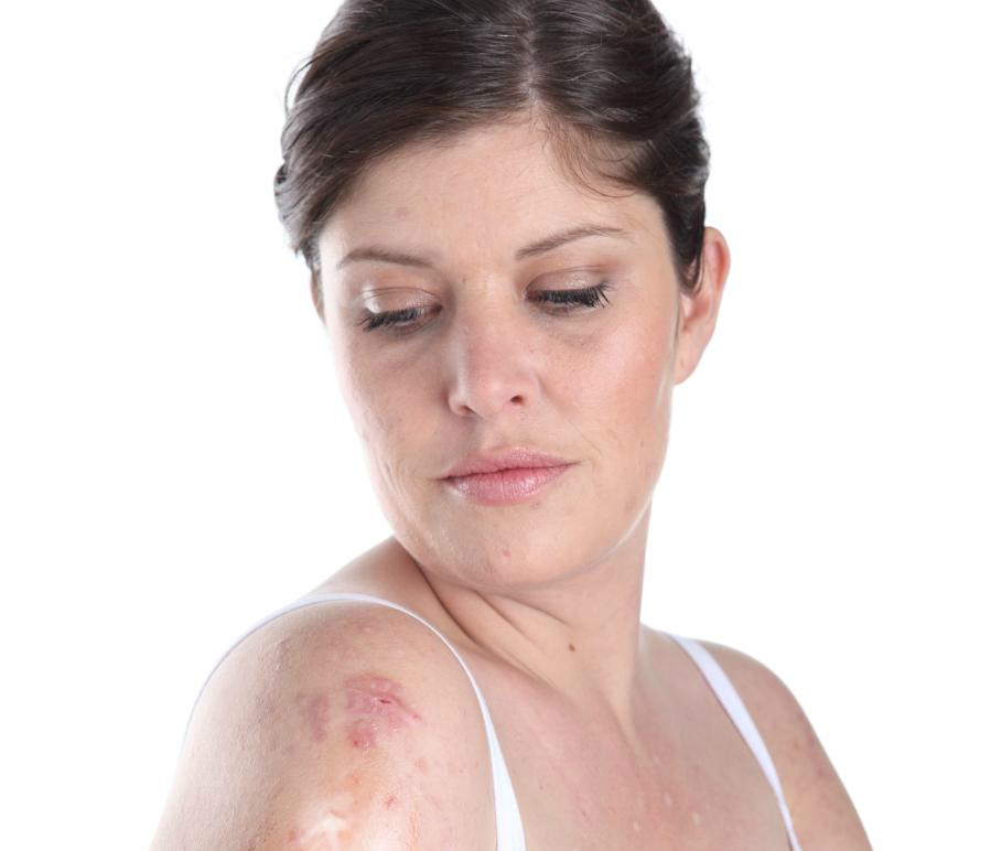 La psoriasis no debe esconderse sino tratarse