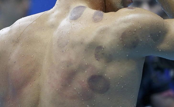 El cupping de Phelps, conocido en el mundo musulmán desde hace siglos