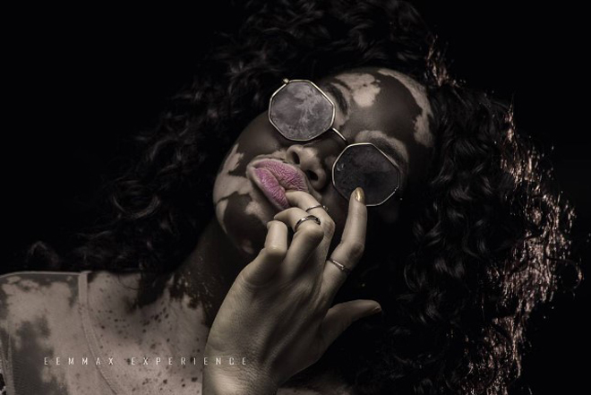 Una enfermera con vitiligo que superó el “bullying” y se convirtió en toda una modelo (Fotos)