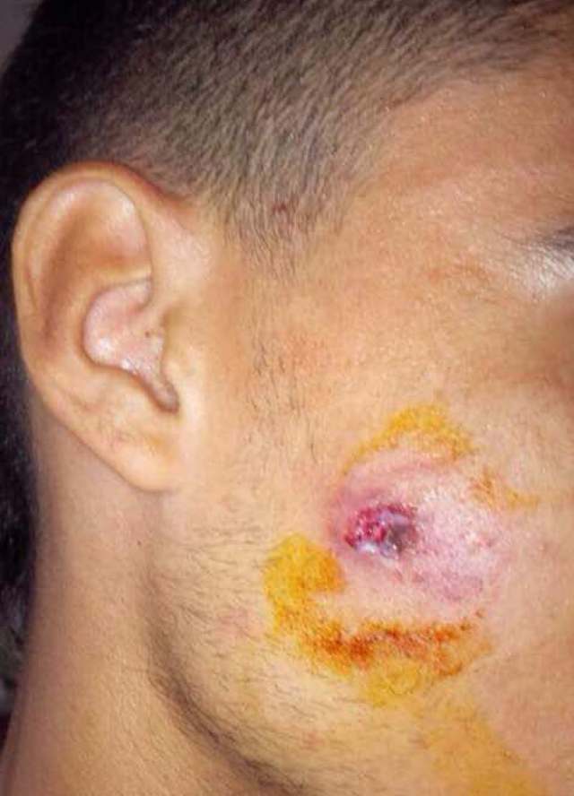 El joven manifestante recibió un perdigonazo en la cara por parte de un GNB. Foto: LaPatilla.com