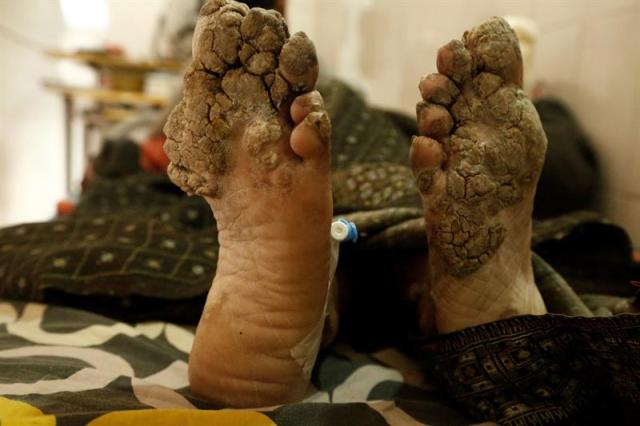 Abul Bajandar, conocido como 'hombre árbol', descansa en una habitación de la unidad de quemados del hospital, en Daca, Bangladés, hoy, 30 de enero de 2018. Bajandar, quien permanecerá dos años en el hospital, ha sido sometido a 19 operaciones para eliminar las verrugas de sus extremidades. EFE/ Abir Abdullah