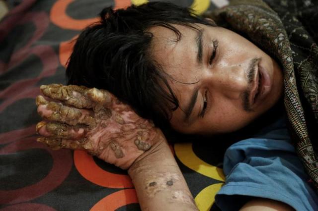 Abul Bajandar, conocido como 'hombre árbol', descansa en una habitación de la unidad de quemados del hospital, en Daca, Bangladés, hoy, 30 de enero de 2018. Bajandar, quien permanecerá dos años en el hospital, ha sido sometido a 19 operaciones para eliminar las verrugas de sus extremidades. EFE/ Abir Abdullah
