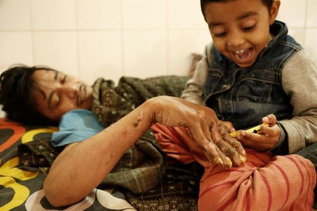  Abul Bajandar (izda), conocido como 'hombre árbol', juega con su hija, Jannatul Ferdous Tahira(dcha), en una habitación de la unidad de quemados del hospital, en Daca, Bangladés, hoy, 30 de enero de 2018. Bajandar, quien permanecerá dos años en el hospital, ha sido sometido a 19 operaciones para eliminar las verrugas de sus extremidades. EFE/ Abir Abdullah