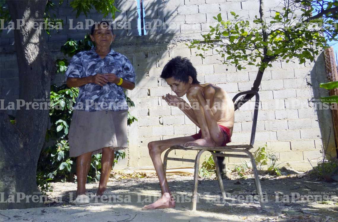 El hambre está acabando con los pacientes neurológicos en Lara