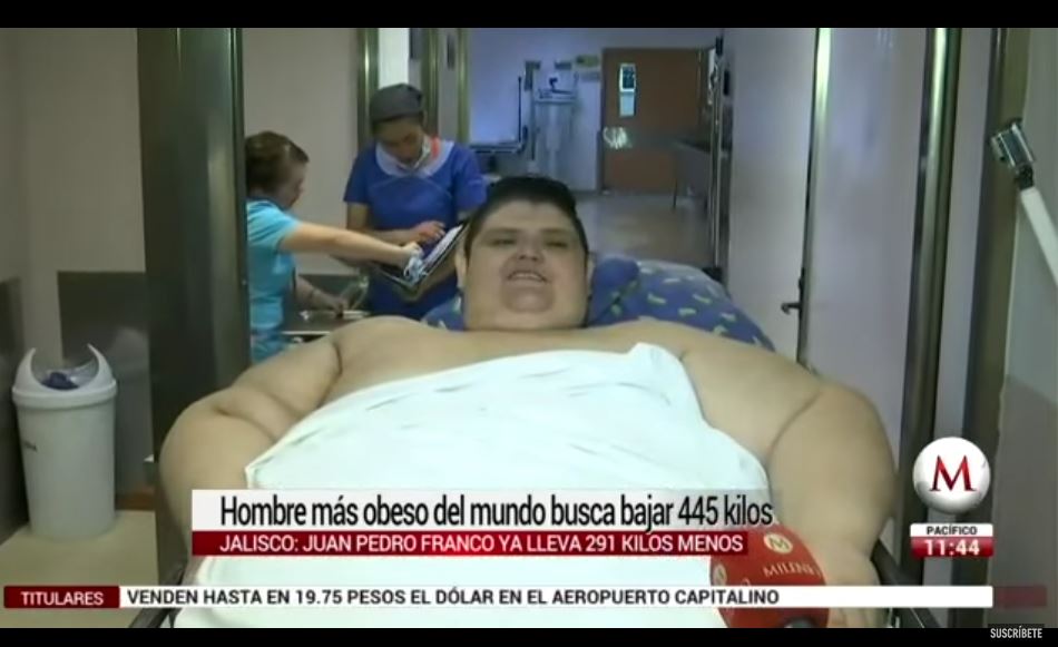 Colocan banda gástrica al hombre más obeso del mundo para mejorar su salud