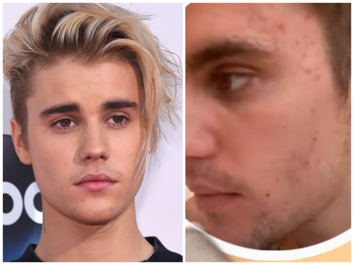 Justin Bieber reveló cómo ha sido su lucha contra el acné severo (+Fotos)