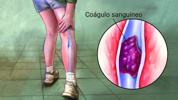 La Trombosis Venosa: una patología poca conocida