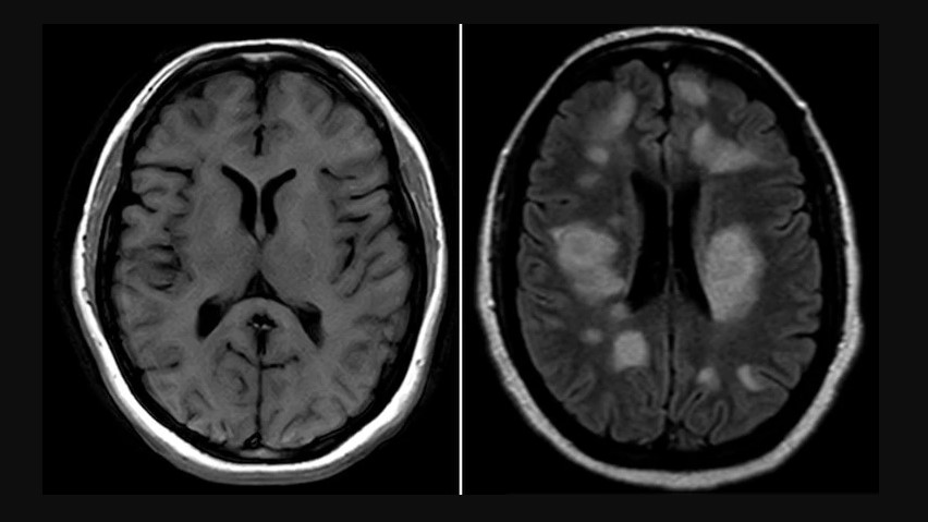 Cómo el uso de drogas impacta en el cerebro: Neuronas “exprimidas” y envejecimiento prematuro