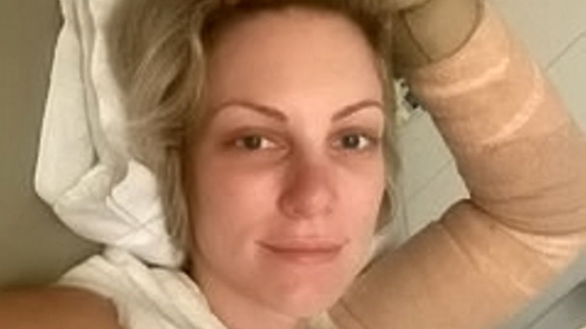 Imágenes sensibles: Californiana se desmayó sobre una sartén caliente y sufrió terribles quemaduras en sus senos