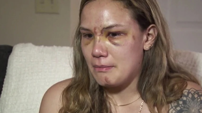 “Me iba a morir y seguía golpeándome”: La brutal golpiza que le dio un hombre sin razón en EEUU