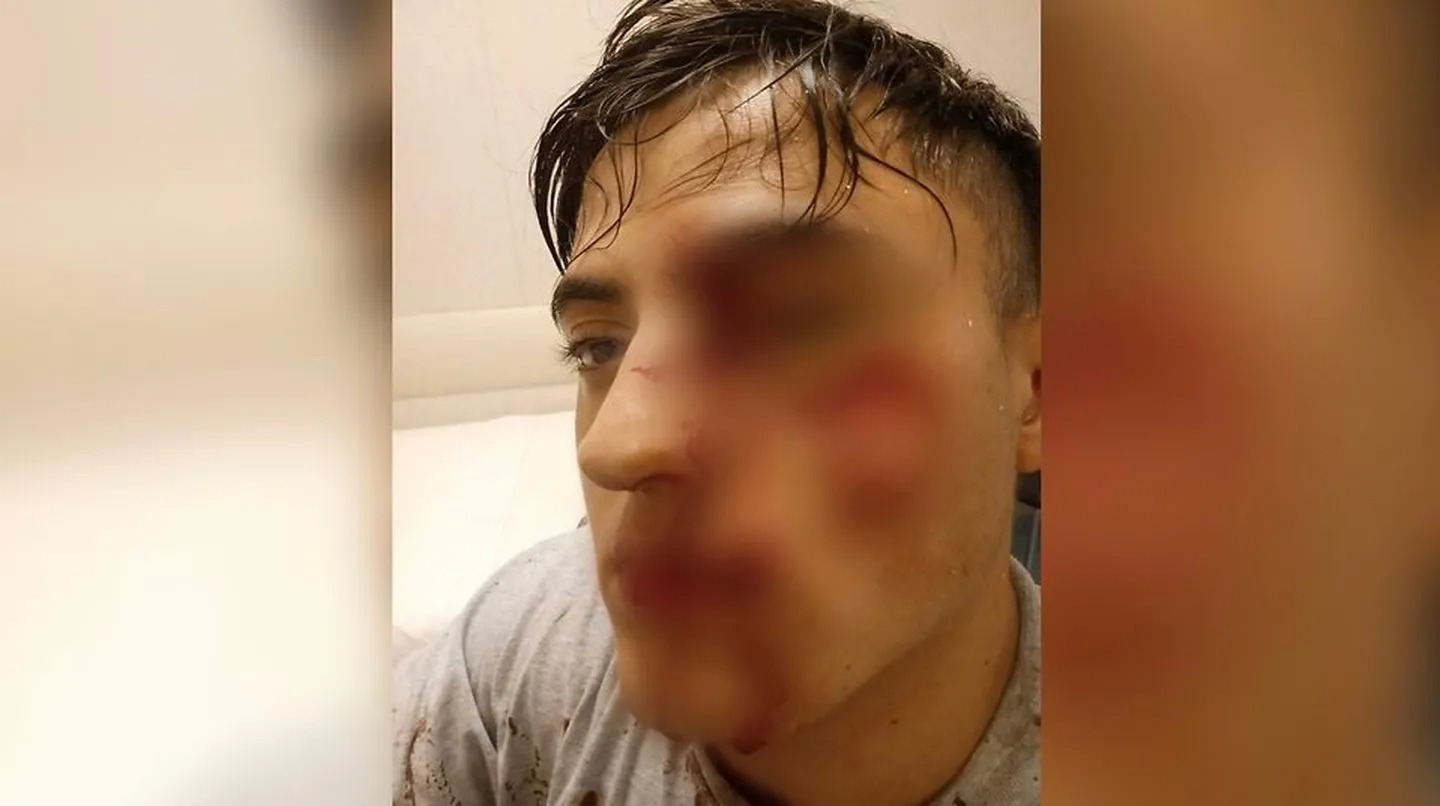 Joven vio a otro conversar con su exnovia, lo atacó con una botella de vidrio y le arrancó parte de la cara