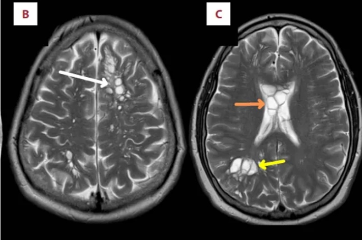 Hallan larvas en el cerebro de un hombre por comer tocino mal cocido en EEUU