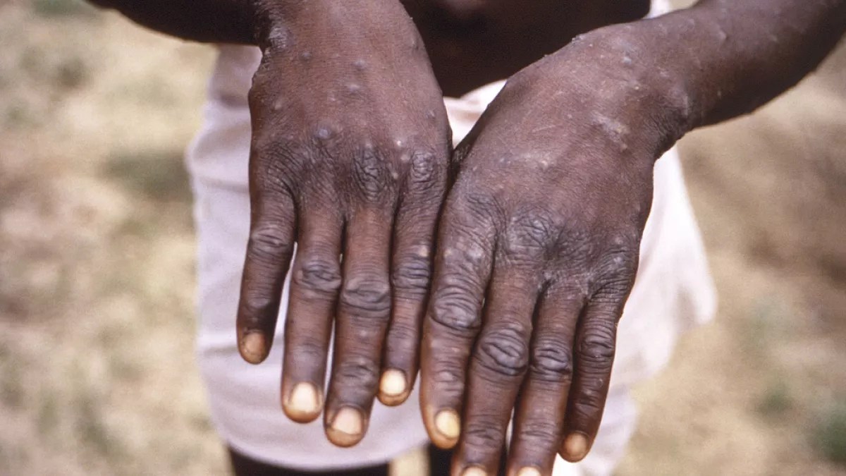 Registrados casi 19 mil casos de mpox y 540 muertes en doce países de África en 2024